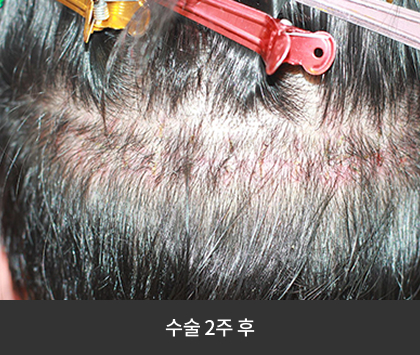 수술2주후