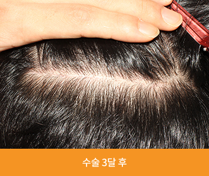 수술3달후