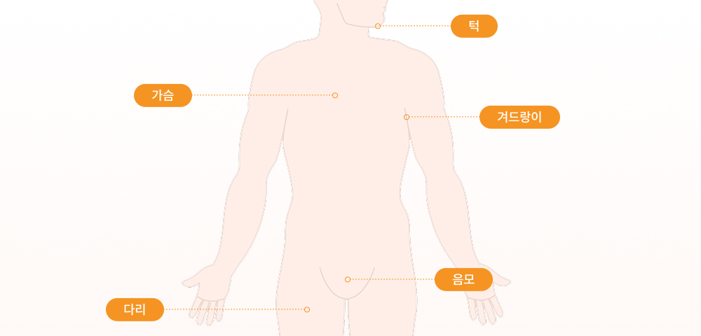 체모이식